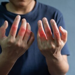 13 choses à savoir sur la vie avec la polyarthrite rhumatoïde
