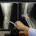 Arthrose des pistes de traitement prometteuses pour la guérir